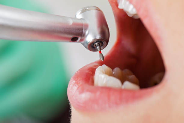 Best Emergency Dental Care for Broken or Chipped Teeth in Farmington, MS